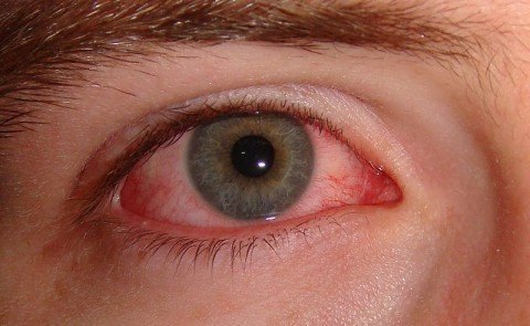 800px-Pink_eye