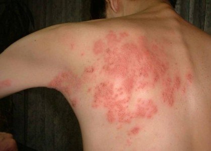 Herpes Zoster
