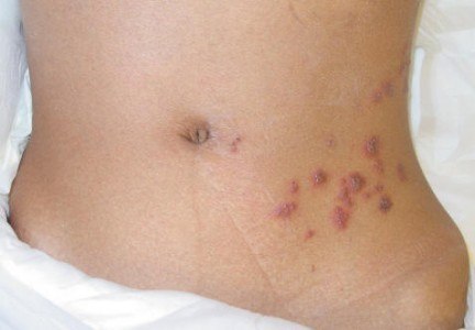 Herpes Zoster
