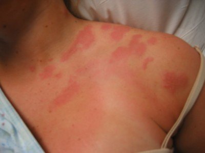 Herpes Zoster