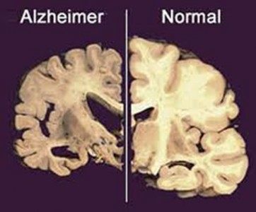 alzheimer y ajedrez cerebro dañado
