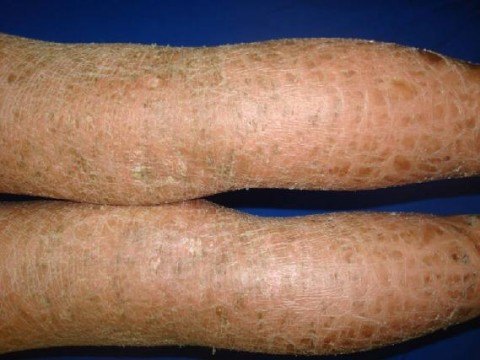 ictiosis