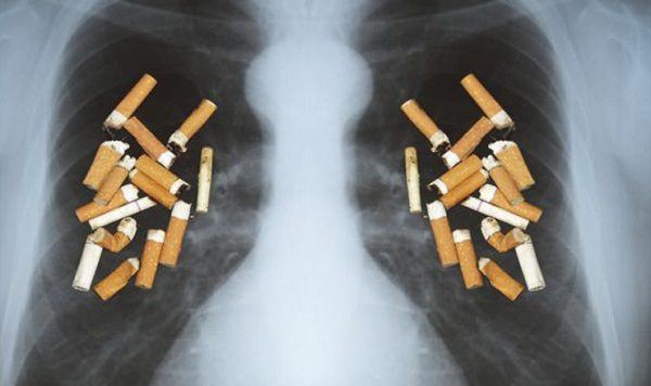 Cáncer De Estómago Con Metástasis Esperanza De Vida