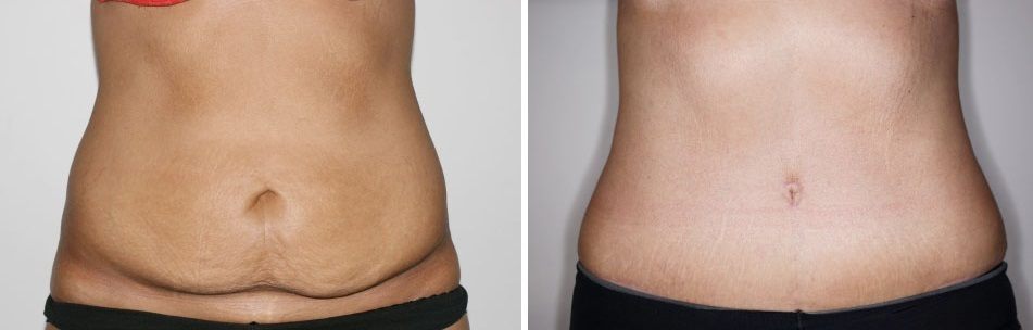 Abdominoplastia para eliminar la flacidez del abdomen - Demedicina.com